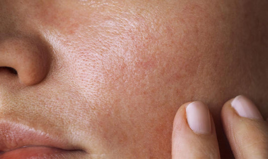 Why does oily skin increase risk of acne?